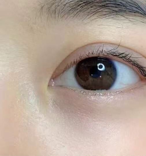 A client's eye before any work, photographed close: a bare lash line with no definition along it.